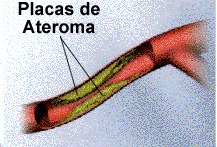 Aterosclerose Coronariana