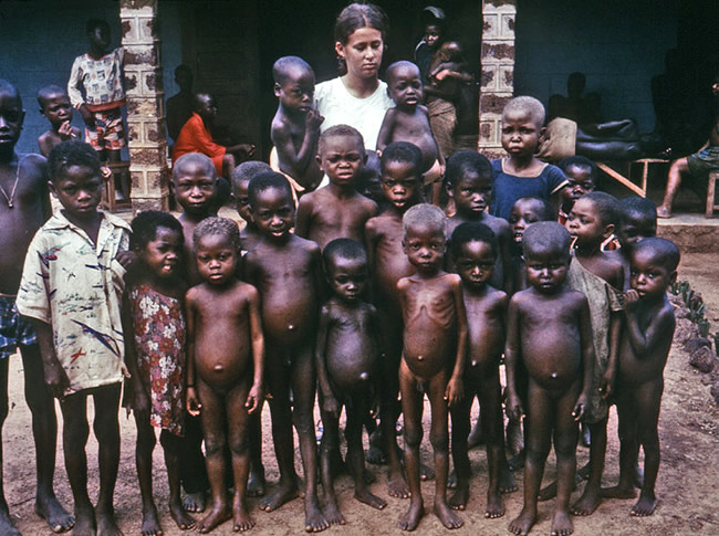 Crianças Subnutridas